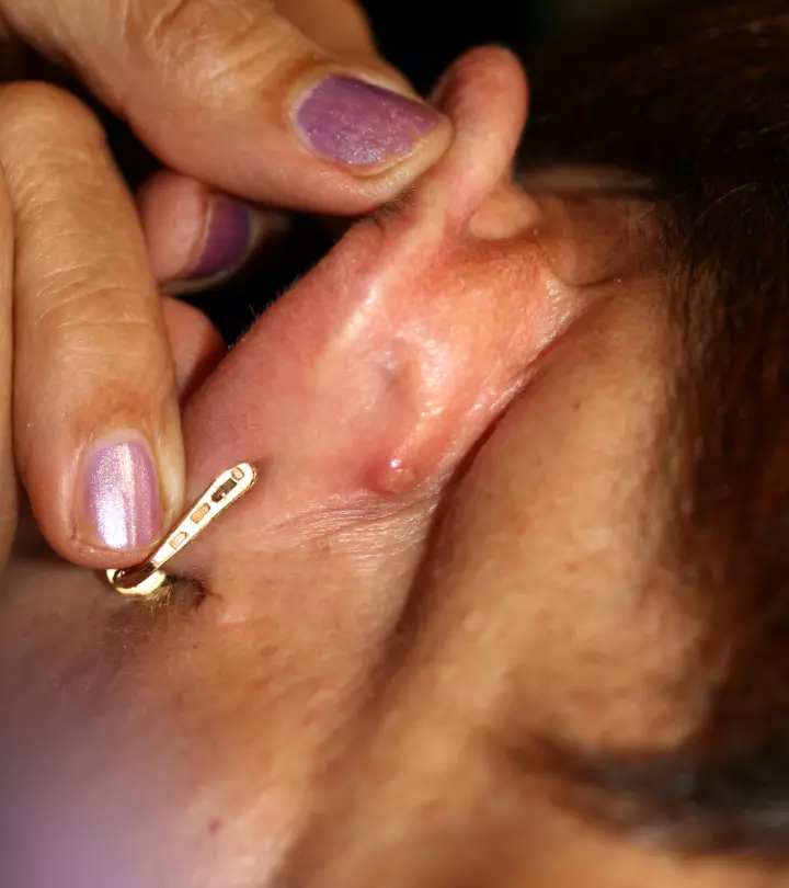 A woman with a cartilage piercing bump