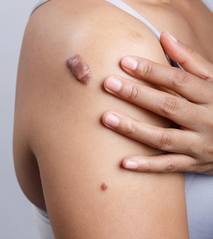 A temporary bump or permanent scar? A guide to every piercing enthusiast’s worst nightmare.