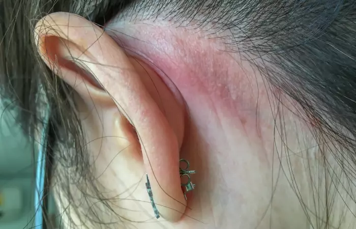 Allergic reaction behind the ear