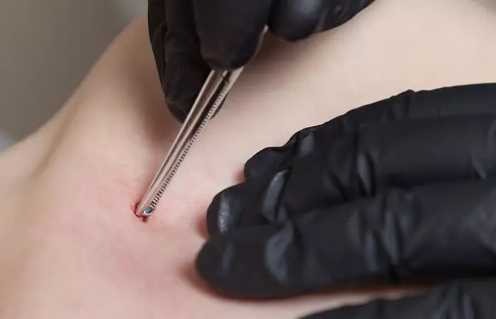 Pain associated with dermal piercing