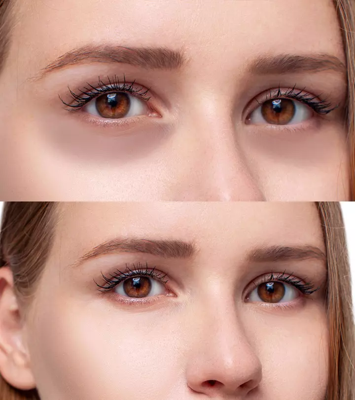 How To Use Milk To Diminish Your Dark Circles?