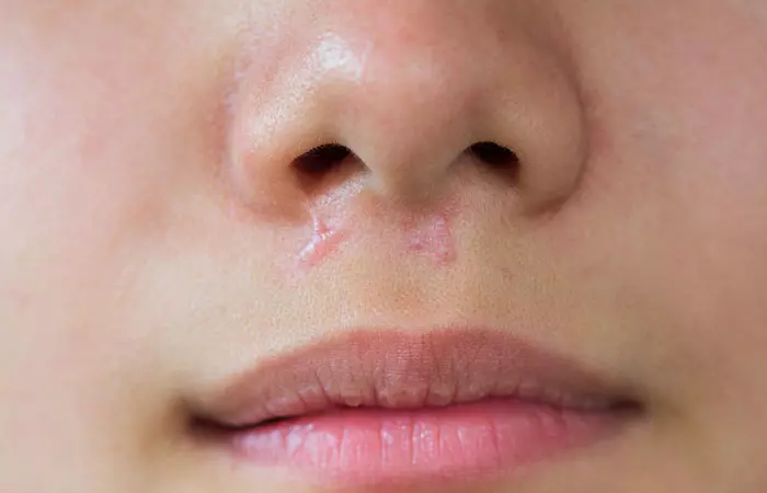 Keloid scar near the nose