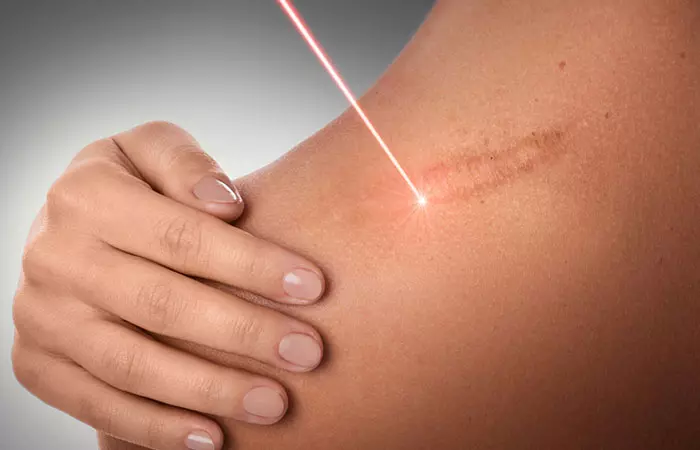Laser therapy for keloid