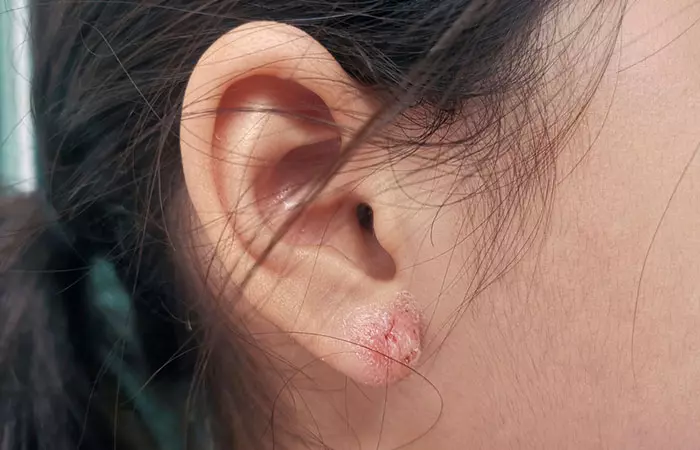 A woman with an ear infection caused due to ear piercings