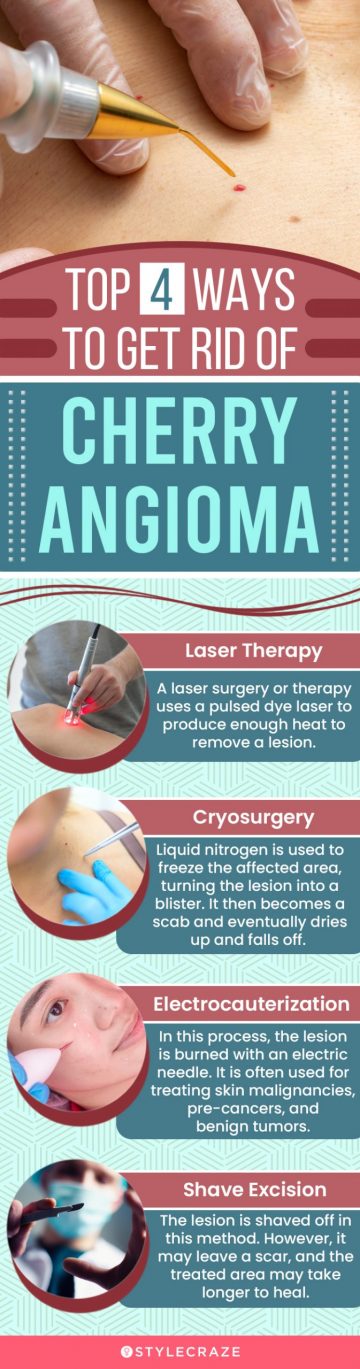 top 4 ways to get rid of cherry angioma (infographic)