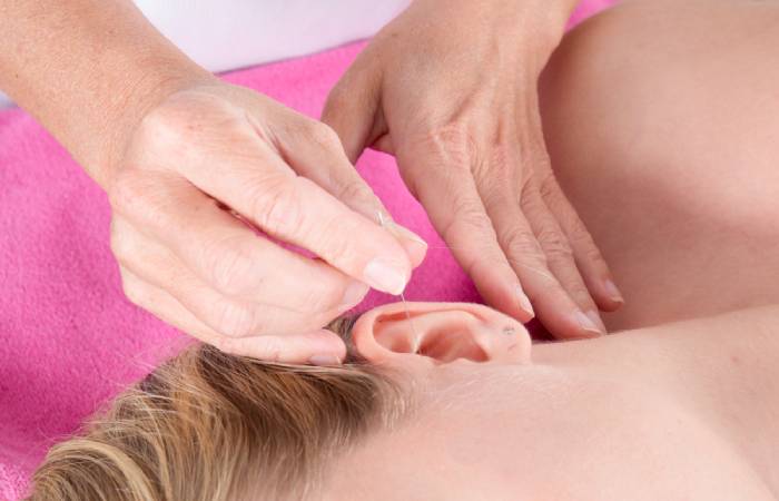 Woman having acupuncture therapy for anxiety