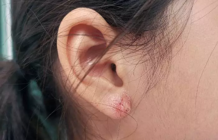 A healing ear wound caused by piercing