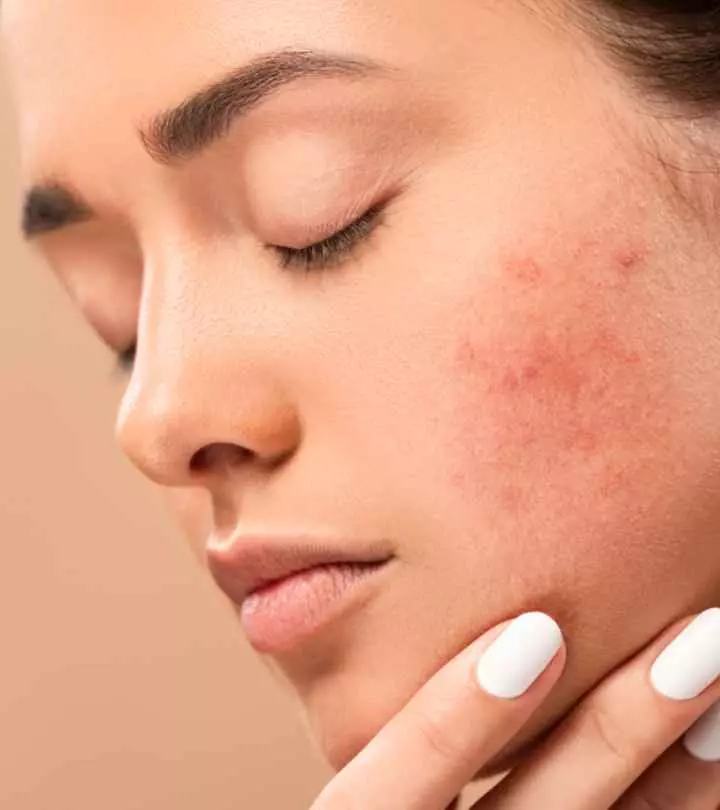 How To Deal With Red And Irritated Skin_