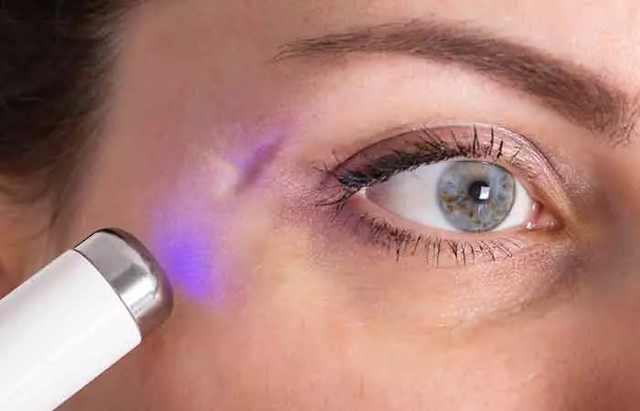 A woman getting her eyebrow scar treated with laser therapy