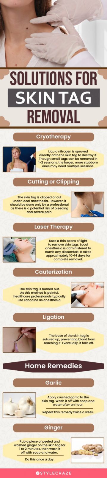 solutions for skin tag removal (infographic)