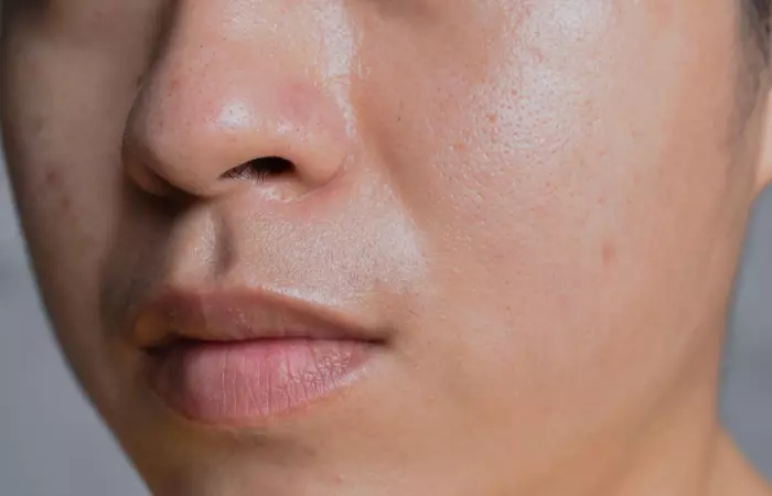 Understanding Oily Skin