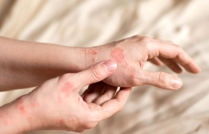 Woman with atopic dermatitis