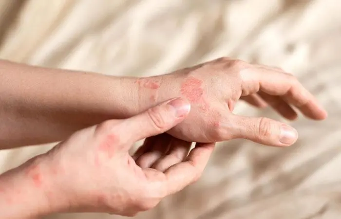 Woman with atopic dermatitis