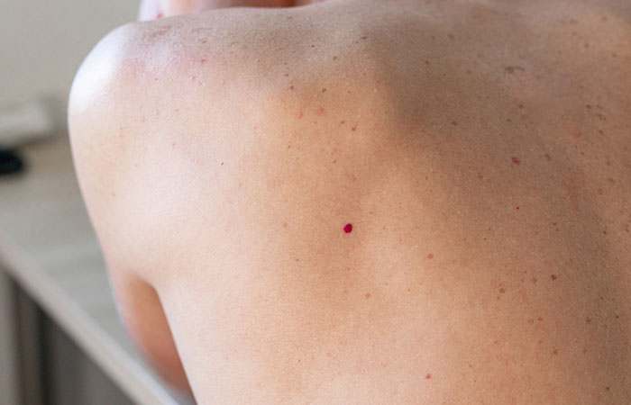 Red Spots On The Skin  Causes  Treatments   How To Get Rid Of Them - 41