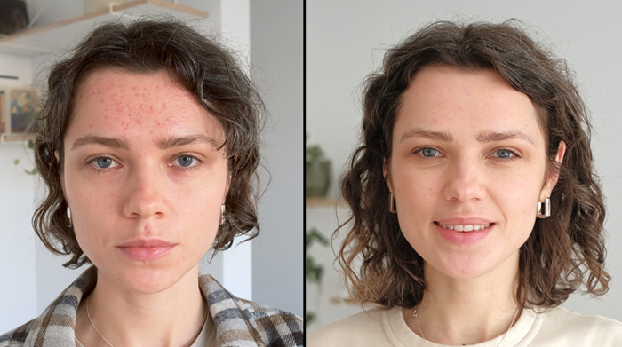 Woman with and without red spots on her face