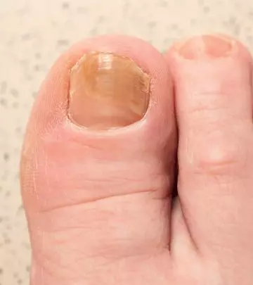 Toenail fungus on a woman’s foot