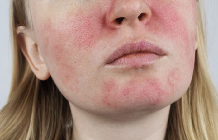 Woman with rosacea