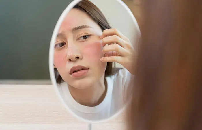 Woman with red spots on face looking in a mirror