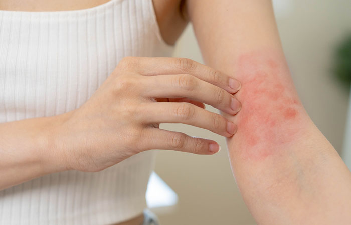 Woman with red spots on her hand