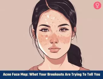 acne face map