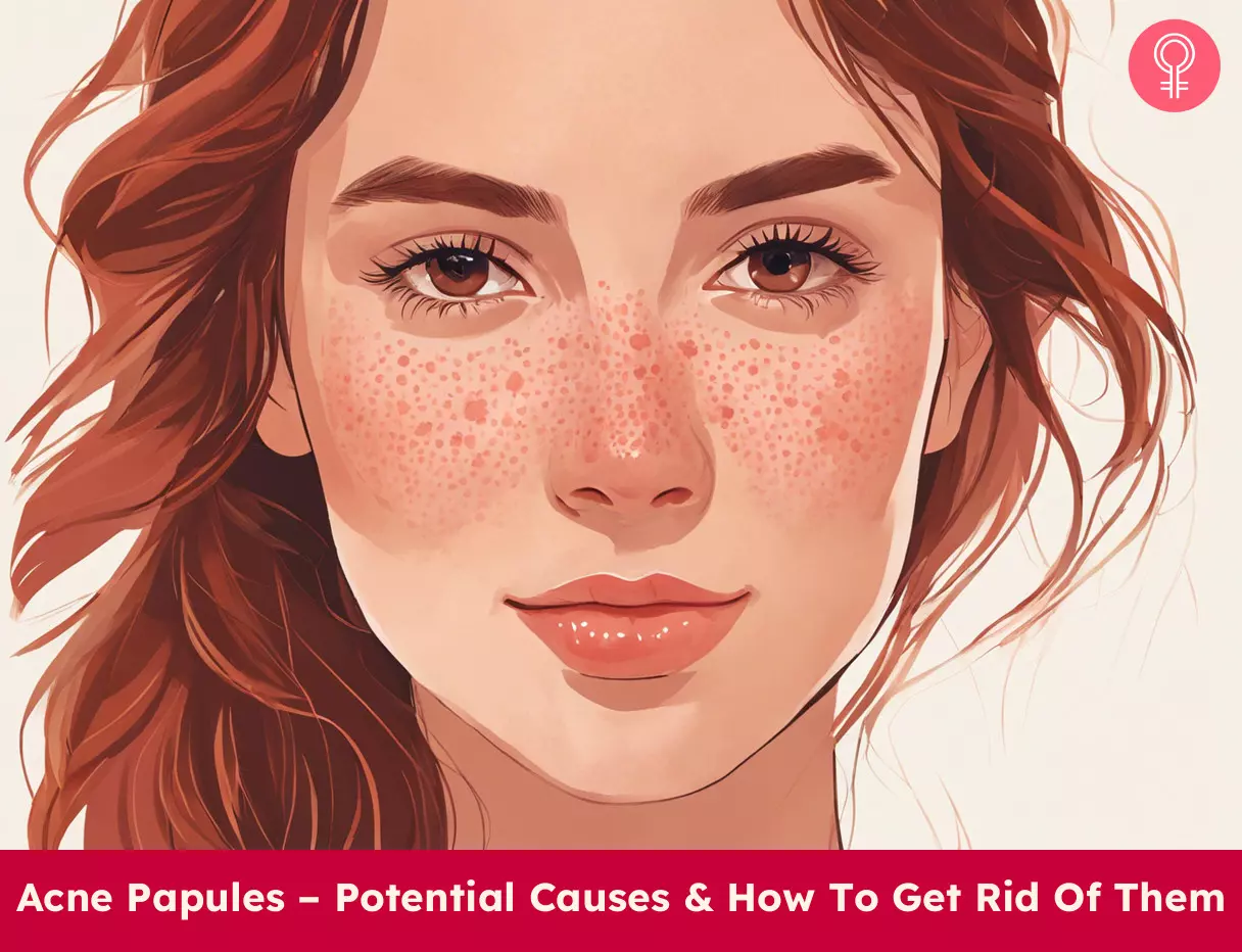 acne papules