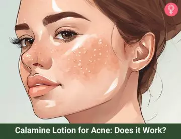 calamine lotion for acne