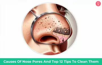 clogged pores on nose_illustration