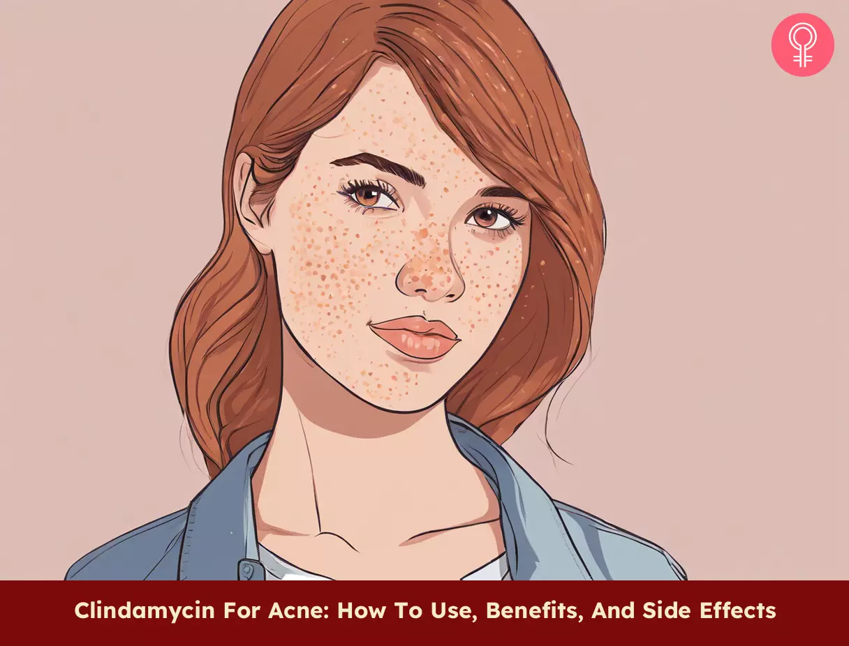 Clindamycin for acne