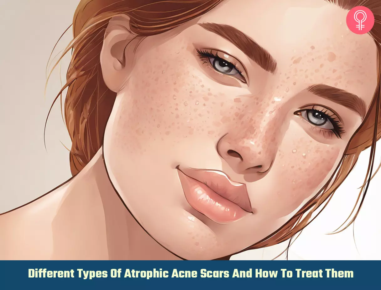 Types of Atrophic Acne Scars