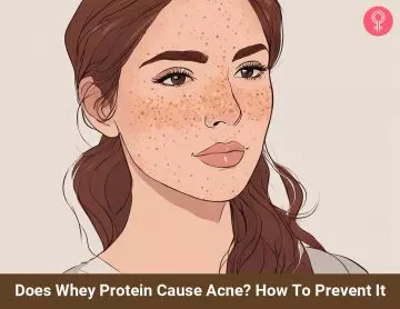 does whey protein cause acne