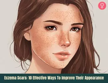 eczema scars