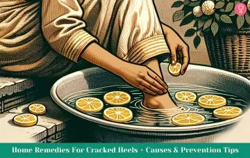 20 Home Remedies For Cracked Heels + Causes & Prevention Tips