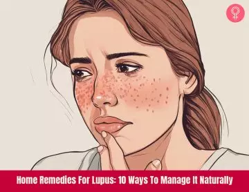 natural remedies for lupus