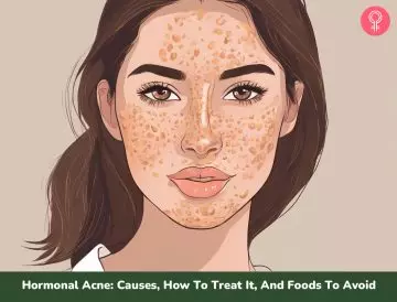 how to treat hormonal acne