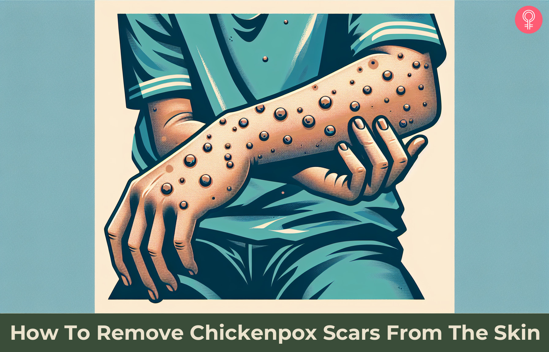 chickenpox scars_illustration