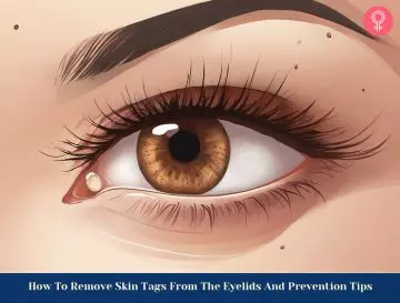 Skin Tags on Eyelids