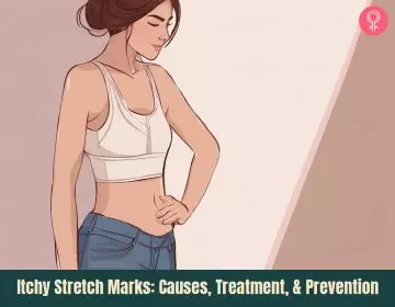 Why Do Stretch Marks Itch
