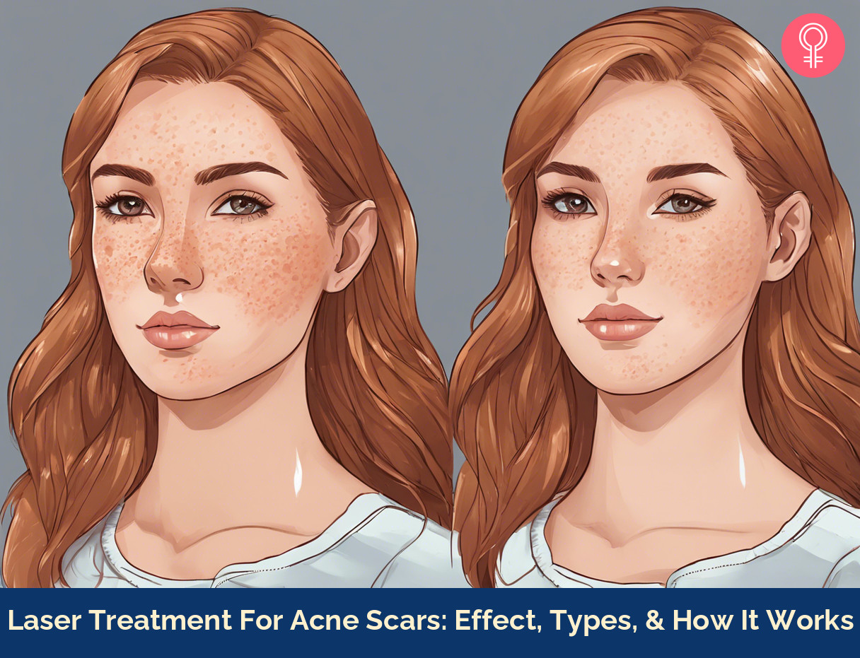 laser treatments for acne scars