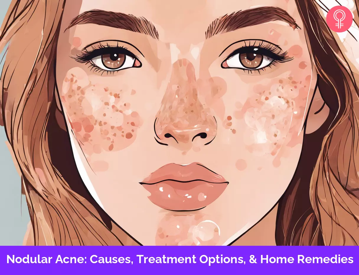 nodular acne