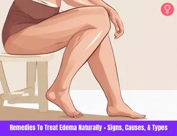 remedies to cure edema