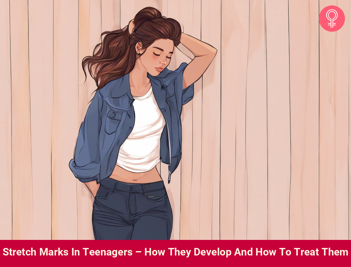 stretch marks in teenagers