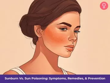 sun poisoning vs sun burn