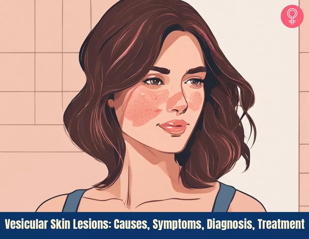 Vesicular Skin Lesions: Causes, Symptoms, Diagnosis, Treatment