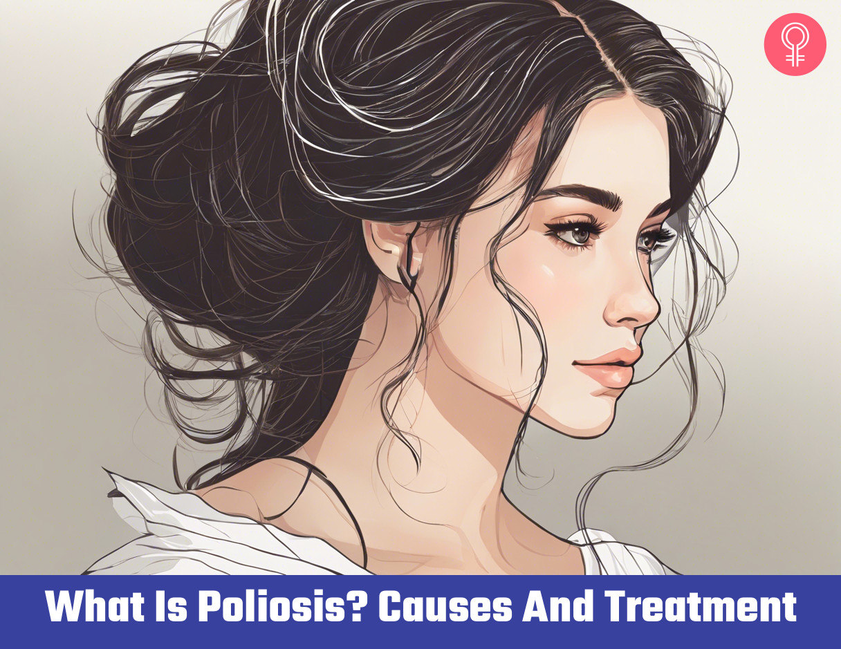 poliosis hair